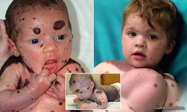 خال های سرطانی